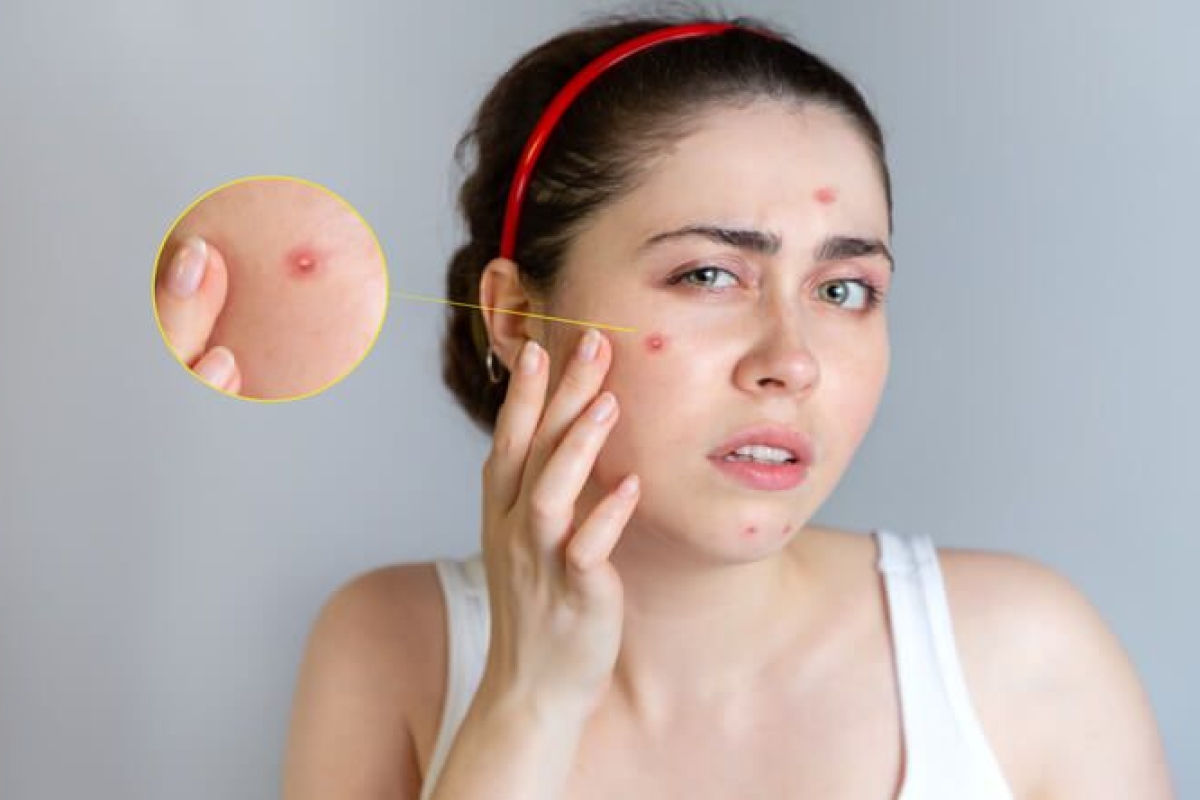 Are You Suffering from Chin Acne? Dermatologist Reveals Key Causes